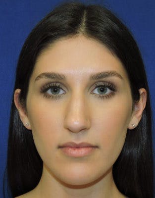 Before & After photos of patient after rhinoplasty