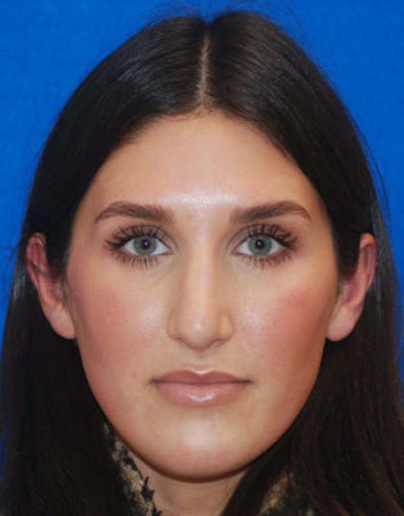 Rhinoplasty Before & After Gallery - Patient 71702716 - Image 8