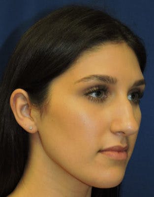 Before & After photos of patient after rhinoplasty