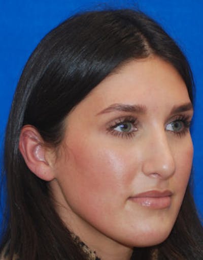 Rhinoplasty Before & After Gallery - Patient 71702716 - Image 2