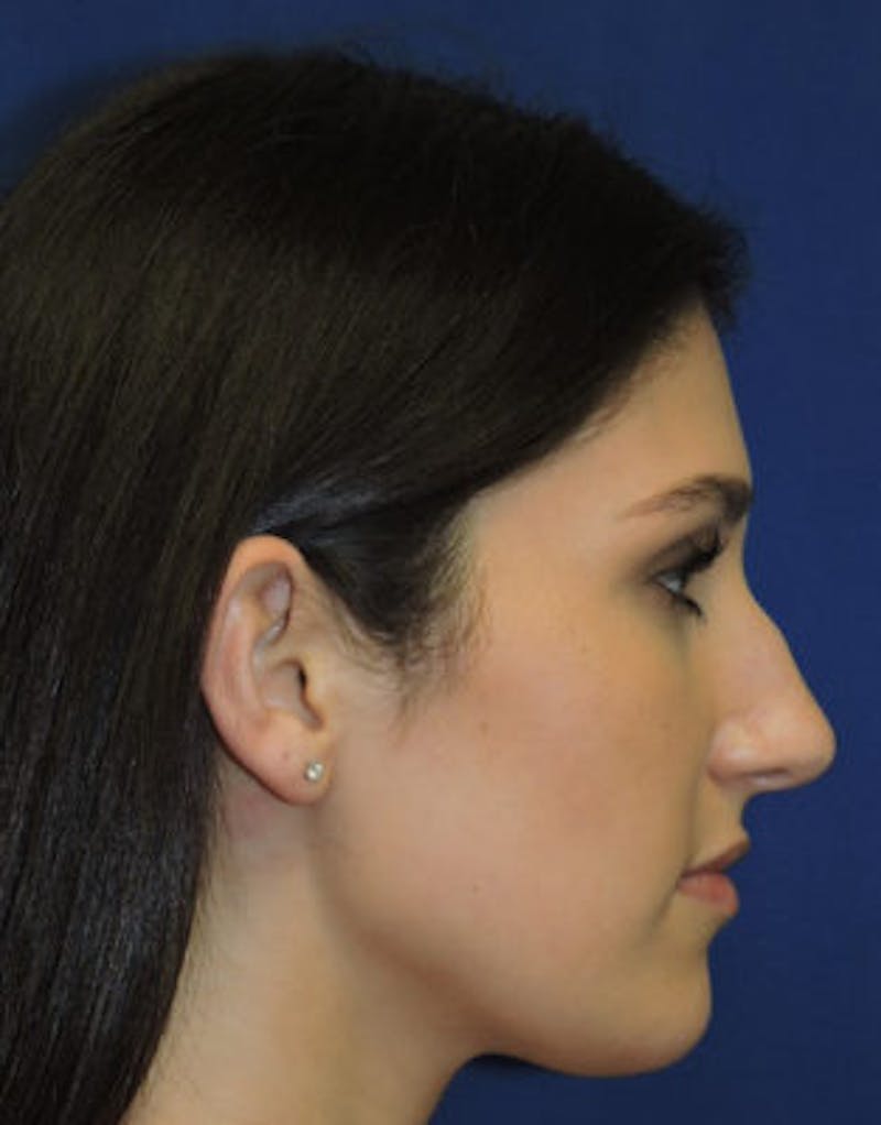Rhinoplasty Before & After Gallery - Patient 71702716 - Image 3
