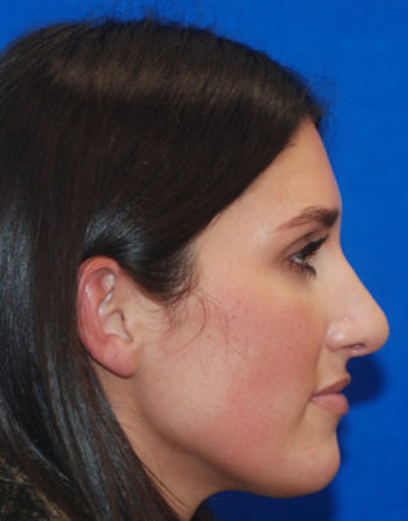 Rhinoplasty Before & After Gallery - Patient 71702716 - Image 4