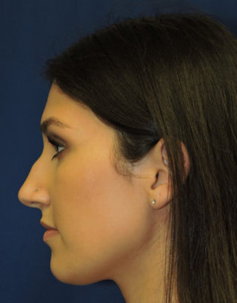 Rhinoplasty Before & After Gallery - Patient 71702716 - Image 5