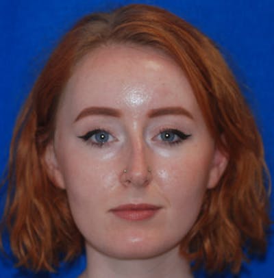Rhinoplasty Before & After Gallery - Patient 71702739 - Image 1