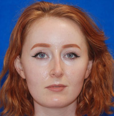 Rhinoplasty Before & After Gallery - Patient 71702739 - Image 2