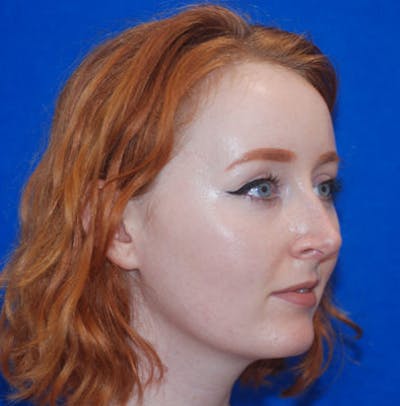Rhinoplasty Before & After Gallery - Patient 71702739 - Image 2
