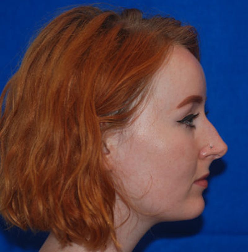Rhinoplasty Before & After Gallery - Patient 71702739 - Image 3
