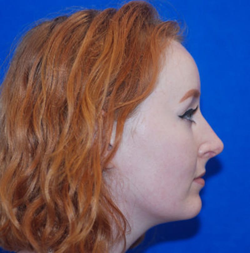 Rhinoplasty Before & After Gallery - Patient 71702739 - Image 4