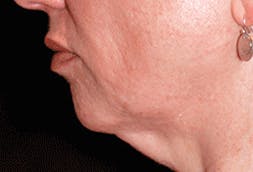 Chin Implant Gallery - Patient 71702822 - Image 5