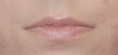 Lip Fillers Before & After Gallery - Patient 71702952 - Image 1