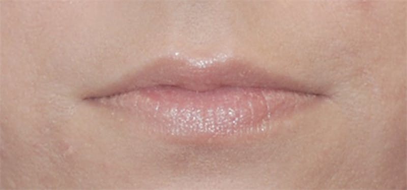 Lip Fillers Before & After Gallery - Patient 71702952 - Image 1