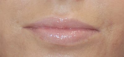 Lip Fillers Before & After Gallery - Patient 71702952 - Image 2