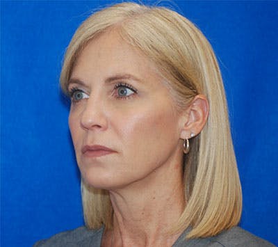 Liquid Facelift Before & After Gallery - Patient 71702955 - Image 2