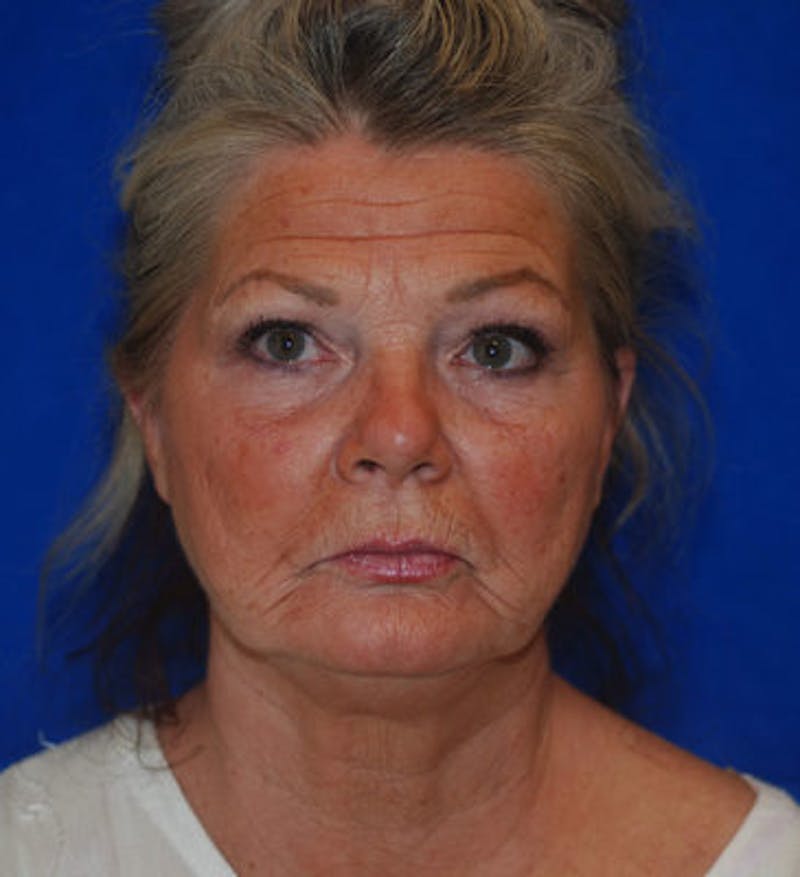 Liquid Facelift Before & After Gallery - Patient 71702969 - Image 1