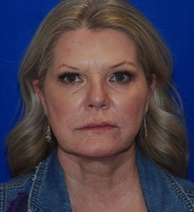 Liquid Facelift Before & After Gallery - Patient 71702969 - Image 2