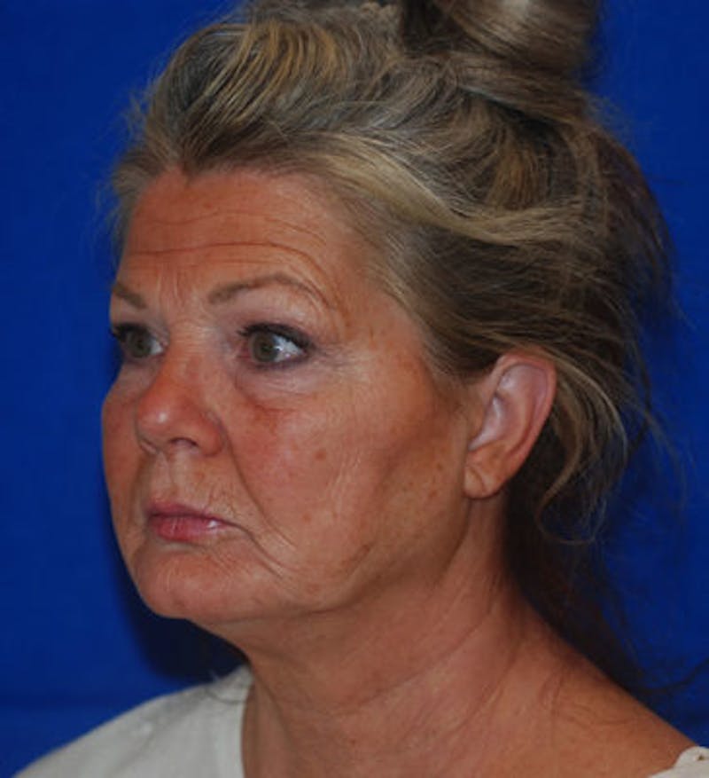 Liquid Facelift Before & After Gallery - Patient 71702969 - Image 3