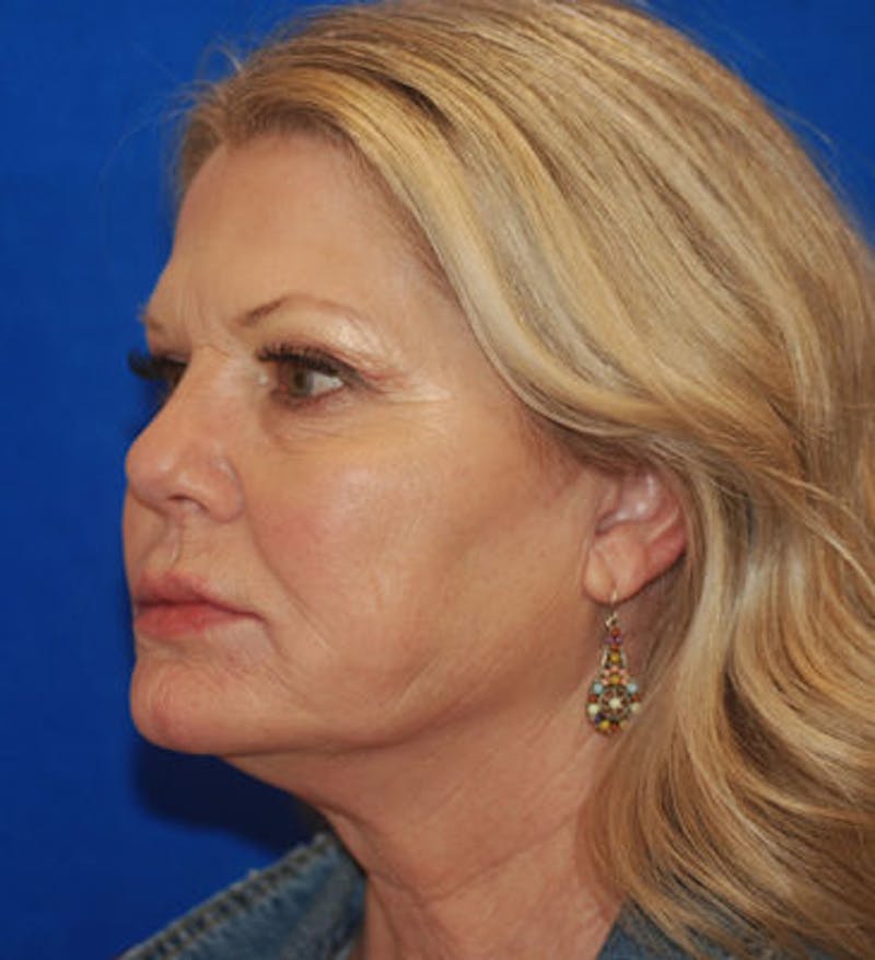 Liquid Facelift Before & After Gallery - Patient 71702969 - Image 4