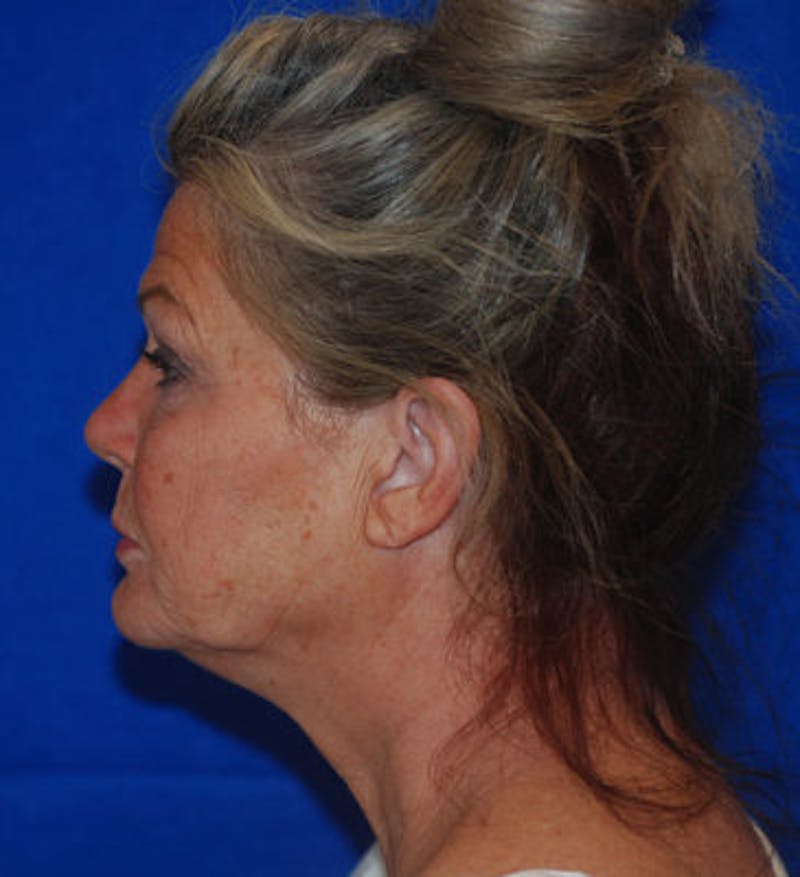 Liquid Facelift Before & After Gallery - Patient 71702969 - Image 5