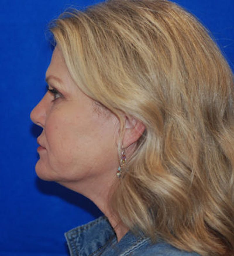 Liquid Facelift Before & After Gallery - Patient 71702969 - Image 6