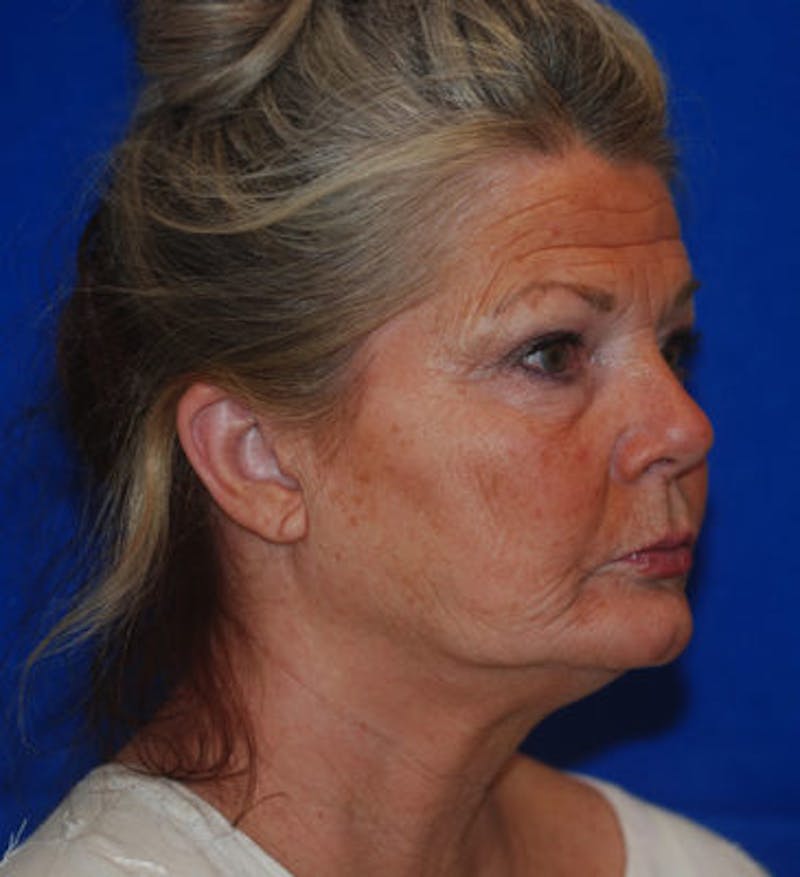 Liquid Facelift Before & After Gallery - Patient 71702969 - Image 7