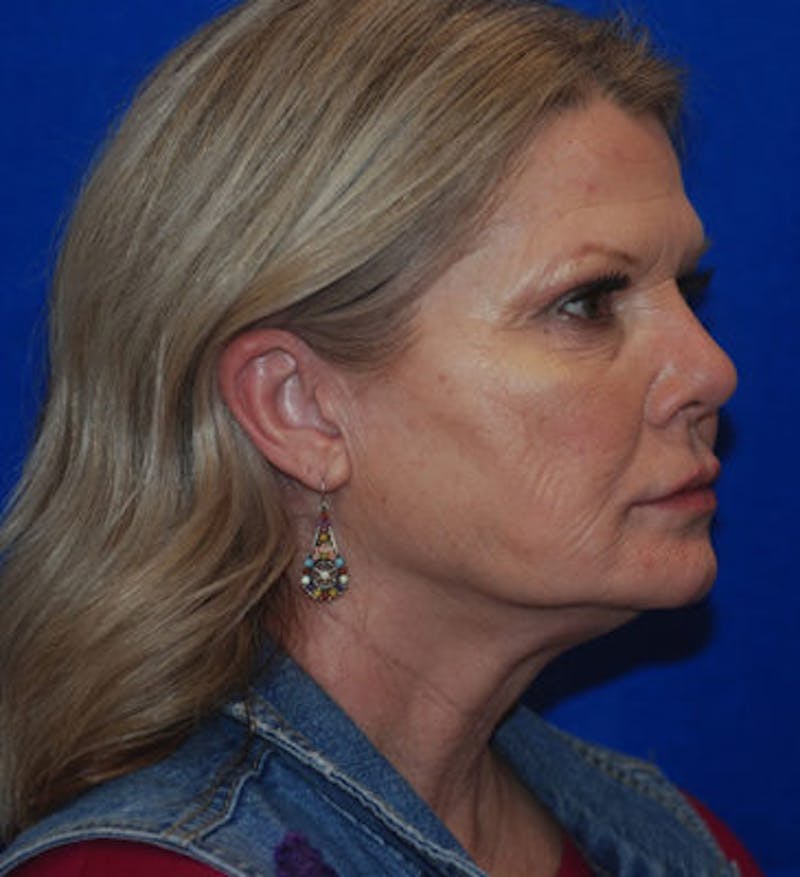 Liquid Facelift Before & After Gallery - Patient 71702969 - Image 8