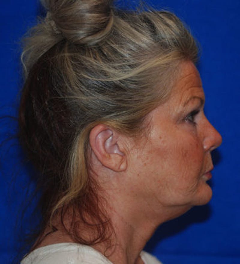 Liquid Facelift Before & After Gallery - Patient 71702969 - Image 9
