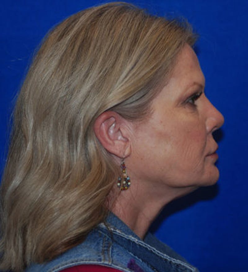 Liquid Facelift Before & After Gallery - Patient 71702969 - Image 10