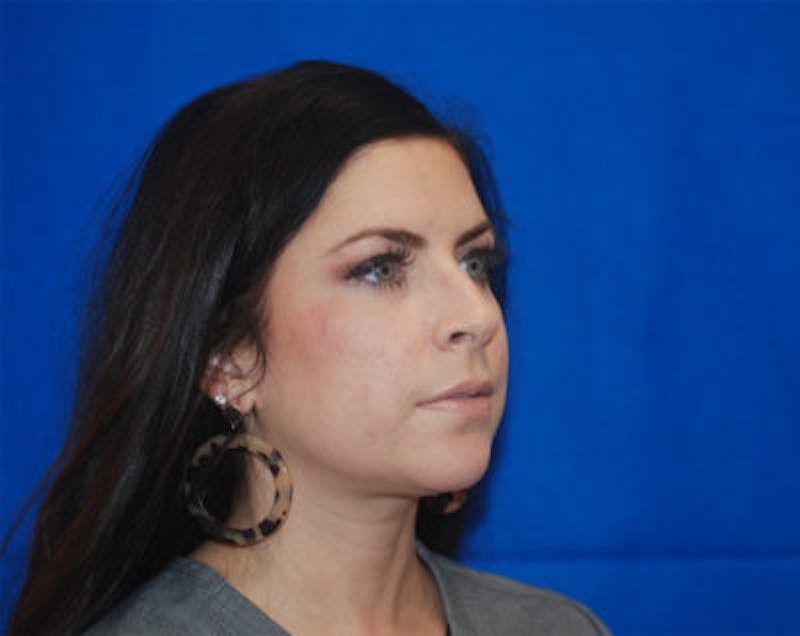 Liquid Facelift Before & After Gallery - Patient 71702987 - Image 3