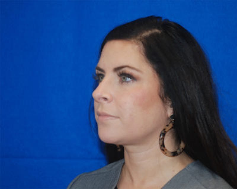Liquid Facelift Before & After Gallery - Patient 71702987 - Image 5