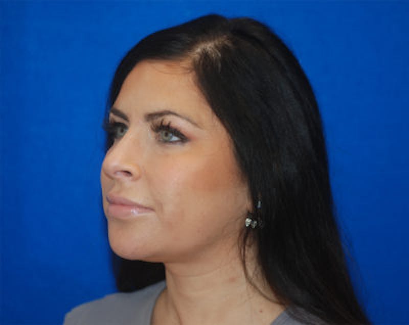 Liquid Facelift Before & After Gallery - Patient 71702987 - Image 6