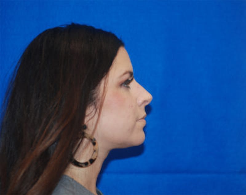 Liquid Facelift Before & After Gallery - Patient 71702987 - Image 7