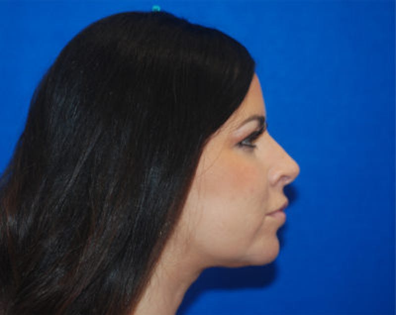 Liquid Facelift Before & After Gallery - Patient 71702987 - Image 8