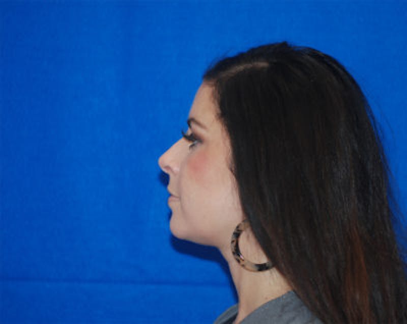 Liquid Facelift Before & After Gallery - Patient 71702987 - Image 9