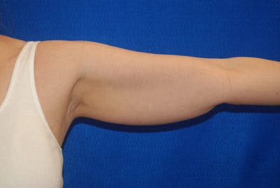 Coolsculpting Before & After Gallery - Patient 71703007 - Image 1