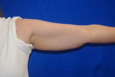 Coolsculpting Before & After Gallery - Patient 71703007 - Image 2