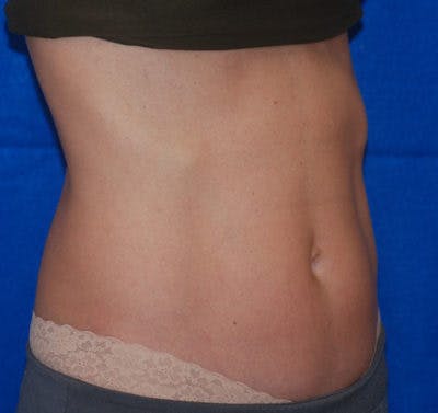 Coolsculpting Before & After Gallery - Patient 71703015 - Image 1