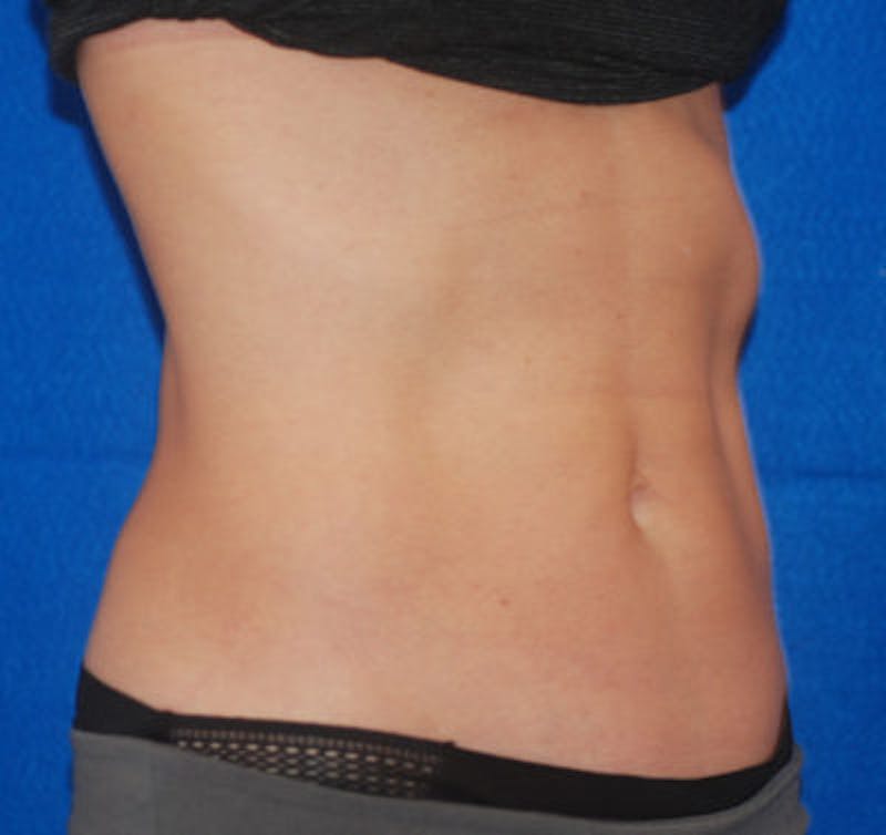 Coolsculpting Before & After Gallery - Patient 71703015 - Image 2