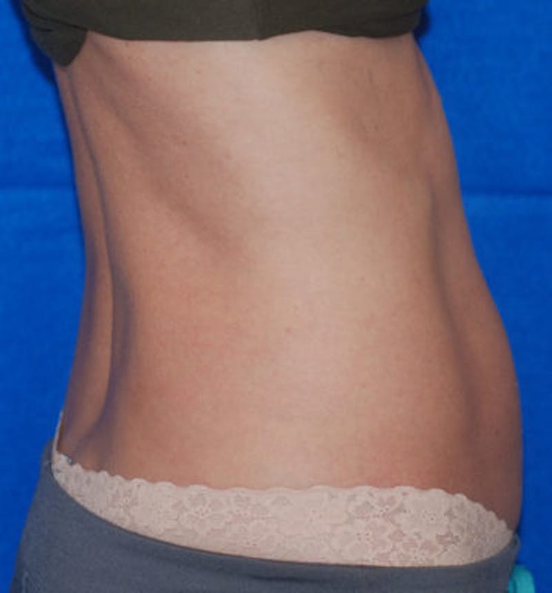 Coolsculpting Before & After Gallery - Patient 71703015 - Image 3