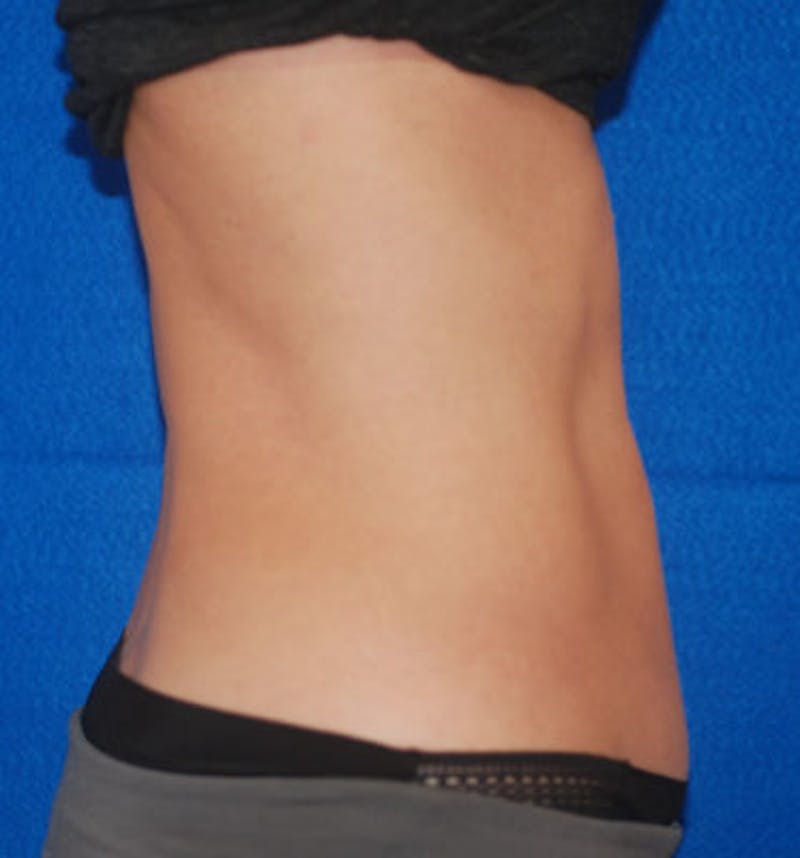 Coolsculpting Before & After Gallery - Patient 71703015 - Image 4