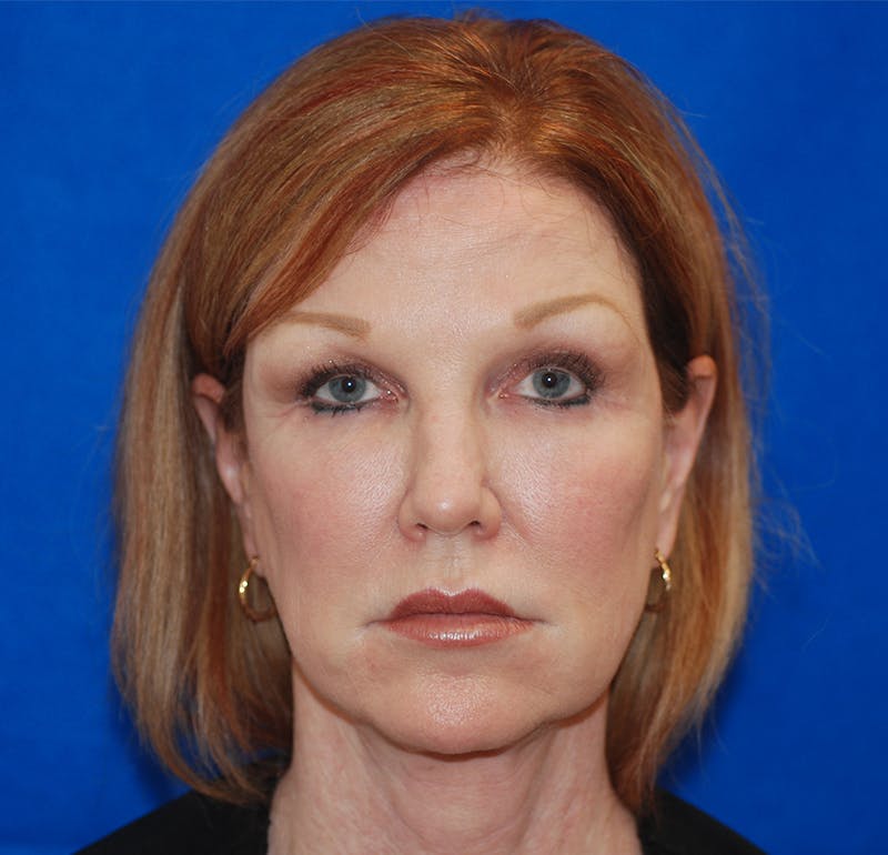 Facelift Before & After Gallery - Patient 83202813 - Image 5