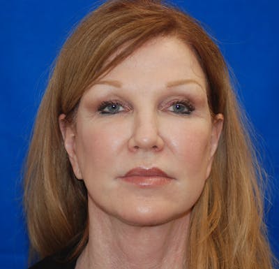 Facelift Before & After Gallery - Patient 83202813 - Image 2