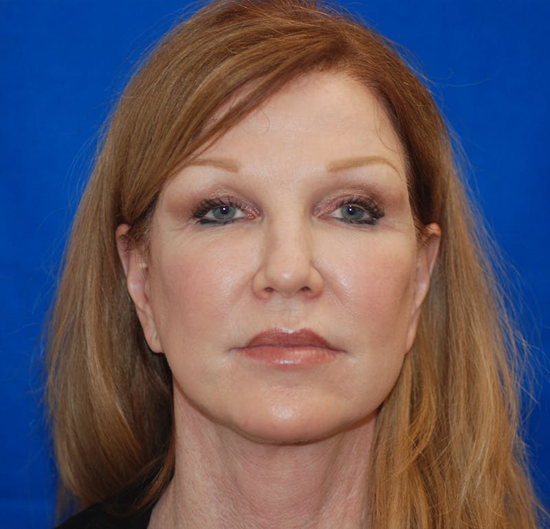 Facelift Before & After Gallery - Patient 83202813 - Image 6
