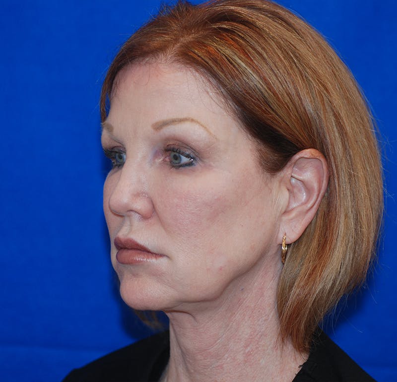 Brow Lift Before & After Gallery - Patient 231758 - Image 3