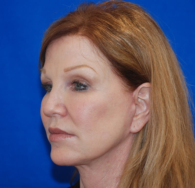 Facelift Before & After Gallery - Patient 83202813 - Image 4