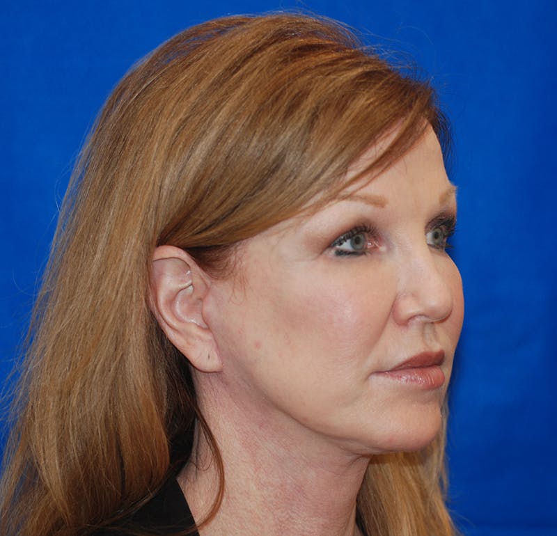 Facelift Before & After Gallery - Patient 83202813 - Image 2