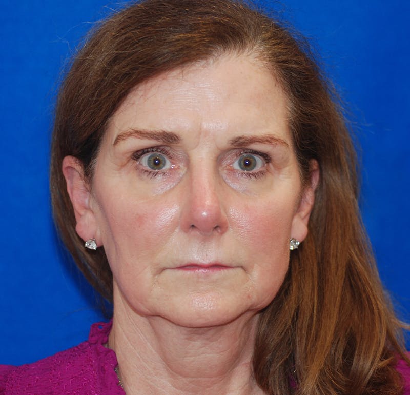 Facelift Before & After Gallery - Patient 83202814 - Image 1