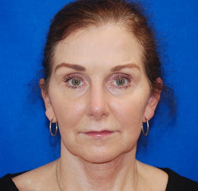 Brow Lift Before & After Gallery - Patient 119147325 - Image 2