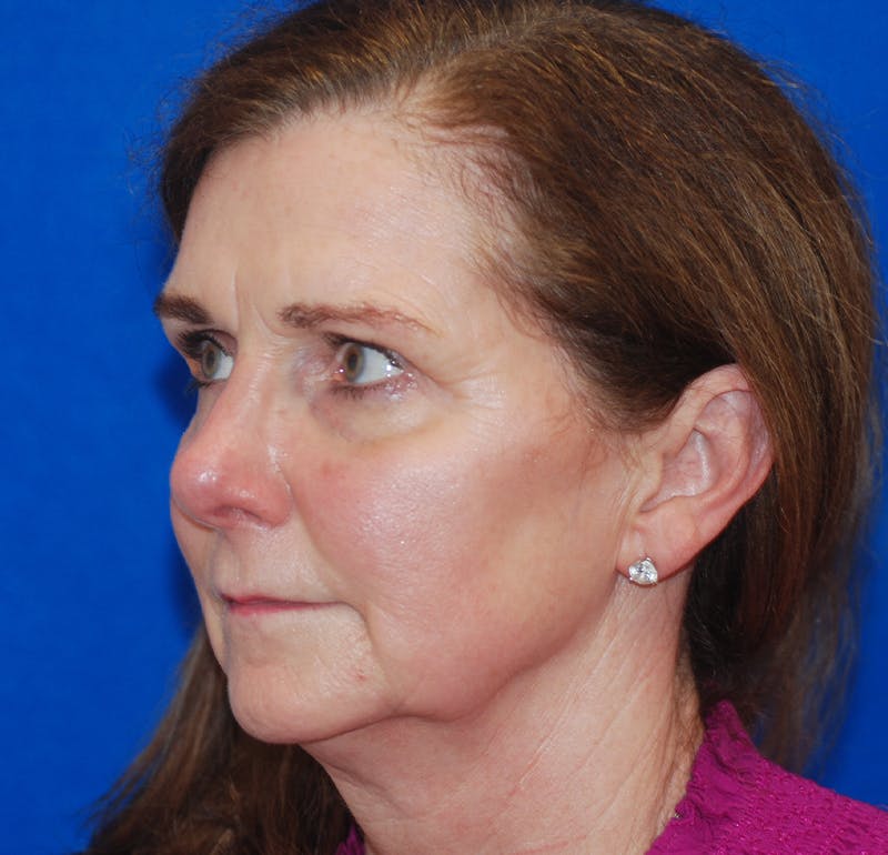 Facelift Before & After Gallery - Patient 83202814 - Image 3