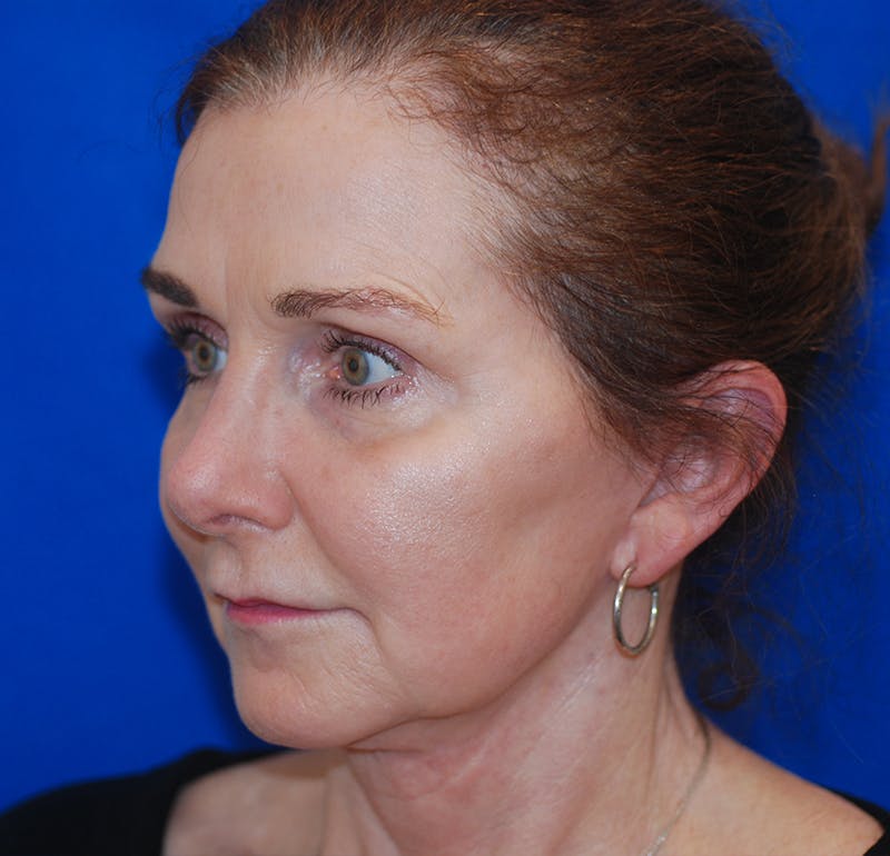 Brow Lift Patient 119147325 After Left Angle