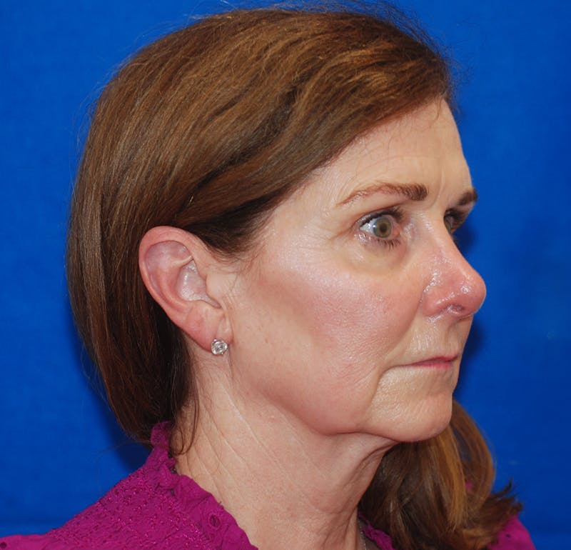 Facelift Before & After Gallery - Patient 83202814 - Image 5